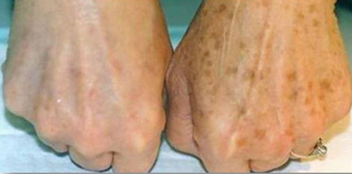 Age Spots