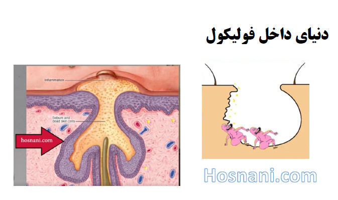 Elevated production of sebum by hyperactive sebaceous glands or blockage of the follicle can cause C. acnes bacteria to grow and multiply