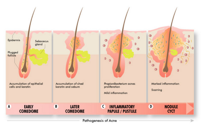 The clinical presentation of acne can range from a mild comedonal form to severe inflammatory cystic acne of the face, chest, and back