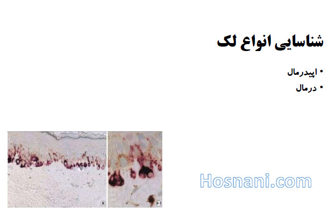 dermal vs epidermal hyperpigmentation2
